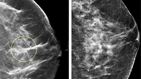 Comparison of a 2D digital mammogram and breast tomosynthesis 3D mammography showing ability to better evaluate details in areas of dense breast tissue, rather than seeing areas of dense breast tissue overlapping, which can mimic or hide a cancer. Photo from UCSF.