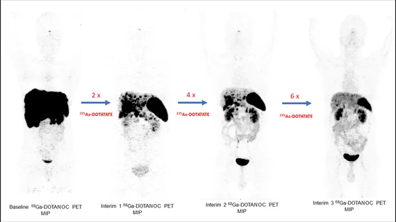 SNMMI abstract of the year, targeted radionuclide therapy