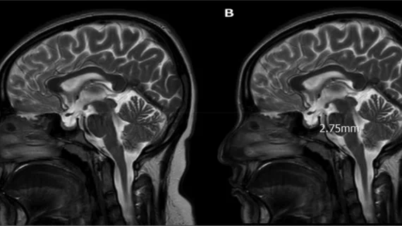 idiopathic intracranial hypertension
