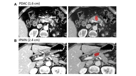 pancreas lesions on CT