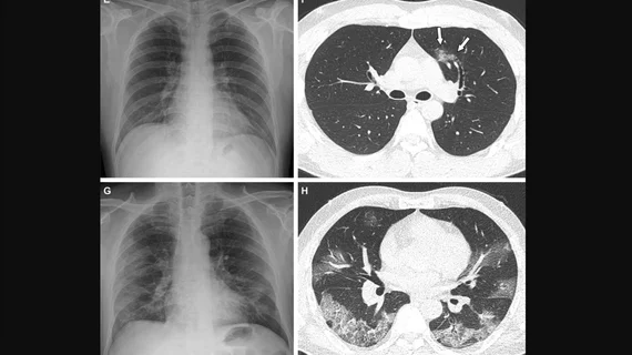 Representative cases showing pneumonia extents and patterns on chest X-ray (CXRs) and CT images. (E and F) A 36-year-old male with no history of vaccination for COVID- 19. The patient had no history of comorbidity. Axial chest CT image obtained on the same day showing unilateral ground-glass opacity with a nonrounded morphology and non-peripheral distribution in the left upper lobe (arrows). RSNA Image. COVID on X-ray, CT scan. What does COVID look like in medical imaging? Example of COVID imaging.