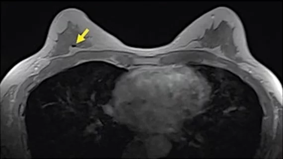 Breast MRI example showing a signal void in right breast (arrow) caused by biopsy on an axial contrast-enhanced in-phase Dixon image. It shows a signal void in right breast (arrow), which corresponded with a MammoMark/CorMark Bread Tie biopsy clip. Image courtesy of AJR.