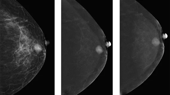 contrast enhanced mammography