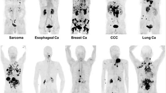 FAPI PET/CT shows promise as a better radiotracer for cancer than 18F-FDG. It also can be used for detection of infection and inflammation.