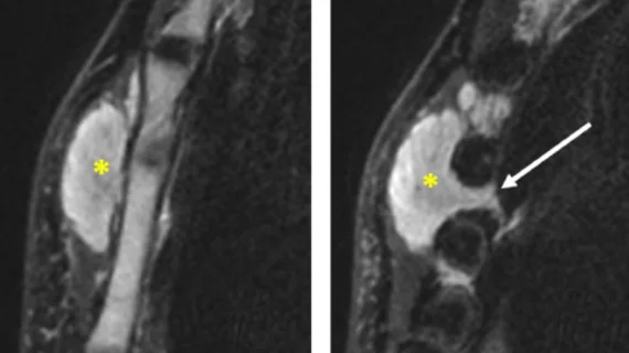 soft tissue lymphoma versus soft tissue tumor soft tissue lymphoma versus soft tissue tumor