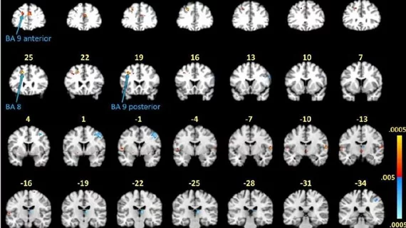 lyme disease on fMRI lyme disease on fMRI
