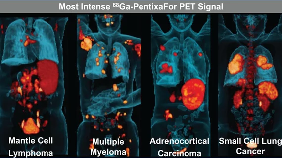 New radiotracer IDs numerous cancers likely to respond to