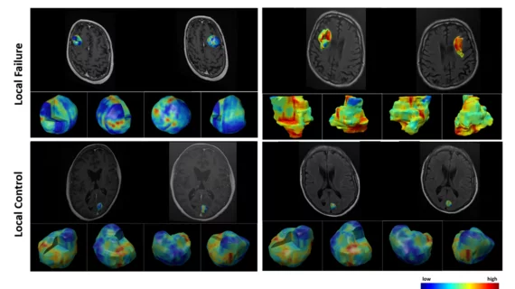 York University researchers demonstrate how AI can help predict brain metastasis outcomes