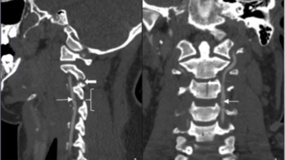 cerebrovascular injury #traumaimaging #vascularimaging #vascularinjury