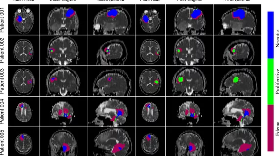 #glioblastoma multiforme #GBM #braintumor