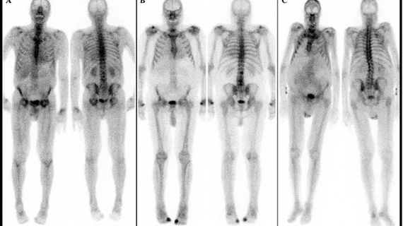 cardiac amyloidosis on bone scan. Image courtesy of the Department of Nuclear Medicine, Medical University of Vienna, Austria.