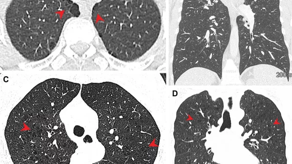 what is worse for your lungs weed or tobacco Combining marijuana and tobacco may be extra bad for your lungs