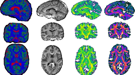 microstructural differences present on diffusion tensor imaging of brains of individuals with ASD
