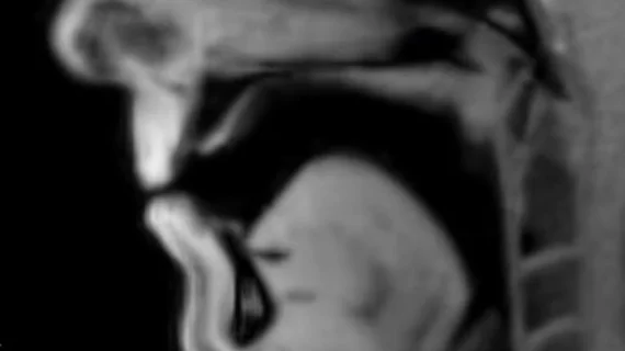 Real-time MRI shows exact mechanisms underlying man's stutter