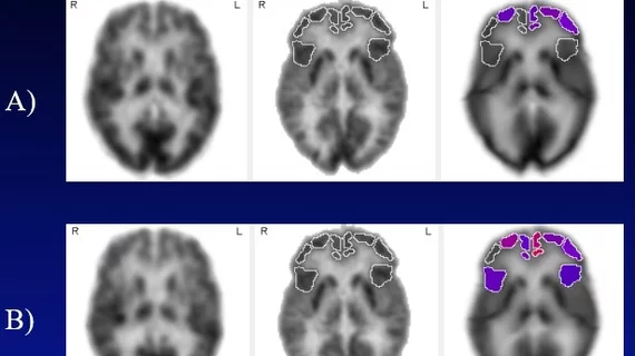 Hearing aids help stall brain aging, new imaging study shows