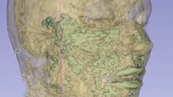 Facial fillers seen on MRI