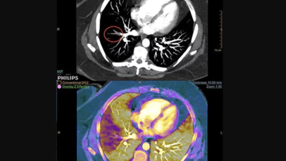 Example of spectral, or dual-energy CT, confirming a pulmonary embolism (PE). Image courtesy of Philips Healthcare