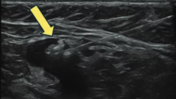 Tattoo ink a promising option for localizing sentinel axillary lymph nodes