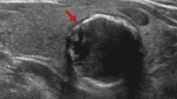 Predictive model helps identify malignancy in thyroid nodules.