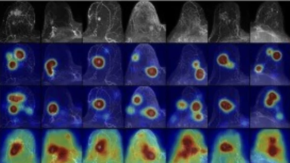 Explainable AI boosts breast cancer detection on MRI