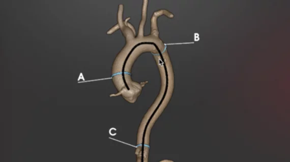 RapidAI's opportunistic aortic management tool earns FDA clearance