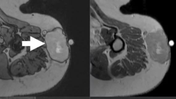 ST-RADS scoring system for predicting risk of soft tissue tumor malignancy