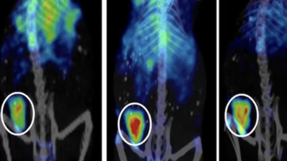 Новая тераностическая технология демонстрирует многообещающие результаты в лечении рака желудка и поджелудочной железы.