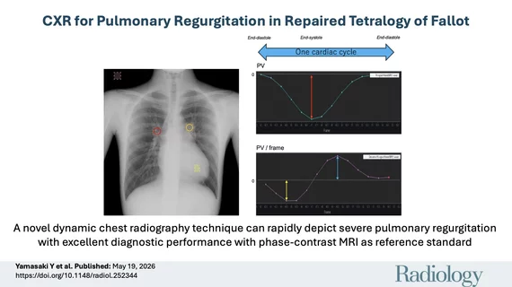 DDR dynamic cardiac X-ray for pulmonary valve regurgitation evaluation. Figure courtesy of RSNA