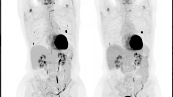 Whole-body PET system reduces image acquisition time.