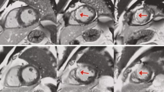 AI helps reduce needs for GBCA use during cardiac MRI scans