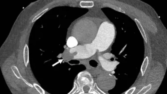 ACR rolls out PE-RADS--new reporting framework for pulmonary embolism