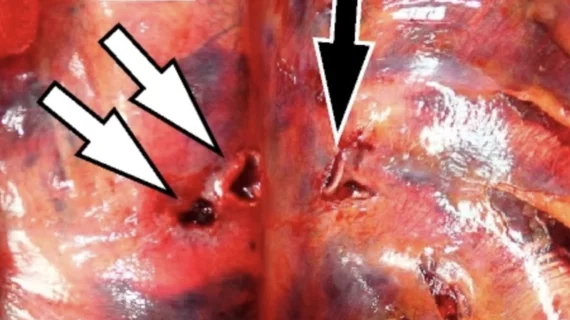 Rib fracture turns deadly after puncturing aorta