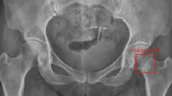 AI spots difficult-to-detect femoral neck fractures