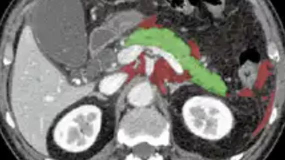 AI tool predicts which acute pancreatitis patients are vulnerable to organ failure