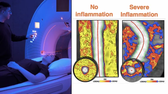 Caristo's fat attenuation index (FAI) AI-assessment for coronary inflammation in CCTA scans can visualize patient's residual cardiac risk not seen on traditional cardiac assessments.