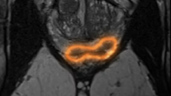 AI performs on par with radiologists at prostate cancer detection across diverse MRI datasets