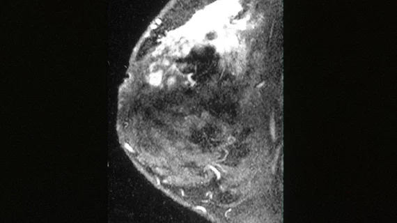 BreastMRI Breast MRI imaging