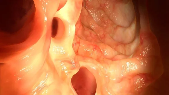 Colonoscopy