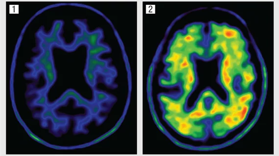 Amyloid