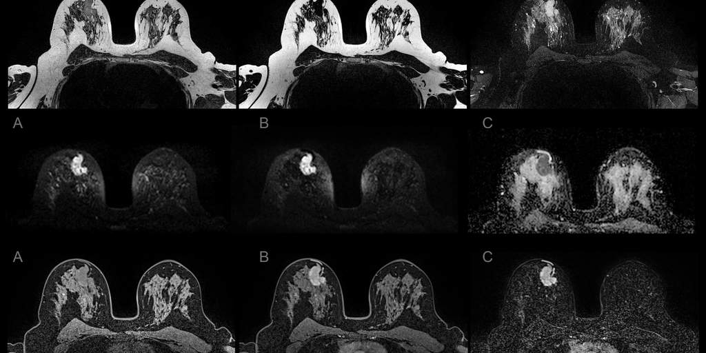 MRI-based radiomics boosts triple-negative breast cancer detection
