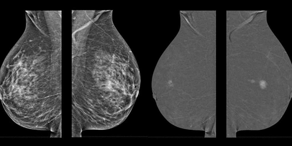 3D mammography approaching 50% of breast imaging systems in the U.S.
