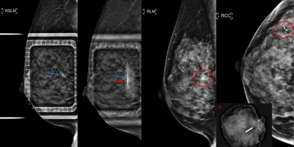 DBT guidance produces a significant drop in procedure time during