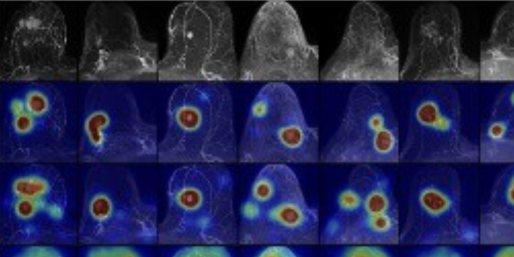 Explainable AI boosts breast cancer detection on MRI